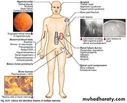 plasma cell tumors