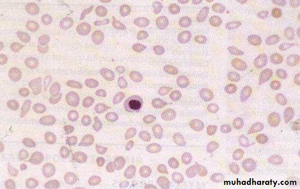 polycythemia
