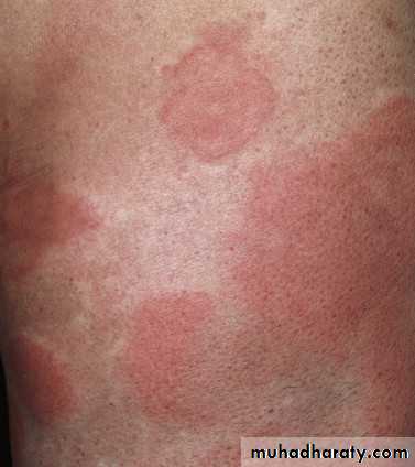 urticaria and angioedema