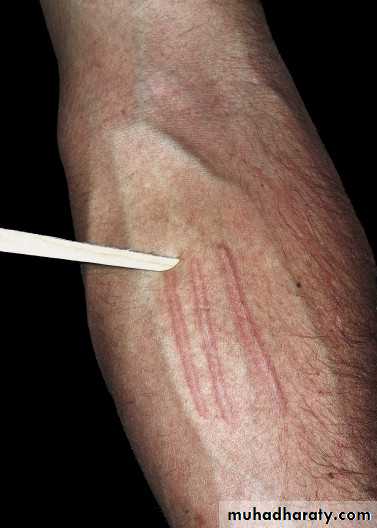 urticaria and angioedema