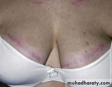 urticaria and angioedema