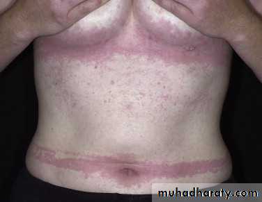 urticaria and angioedema