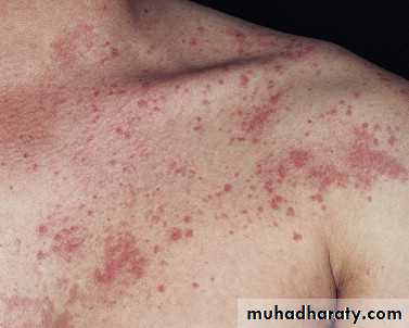 urticaria and angioedema
