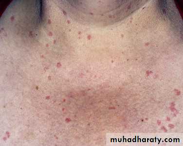 urticaria and angioedema