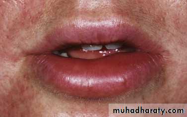 urticaria and angioedema