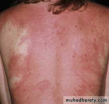 urticaria and angioedema