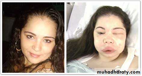 urticaria and angioedema