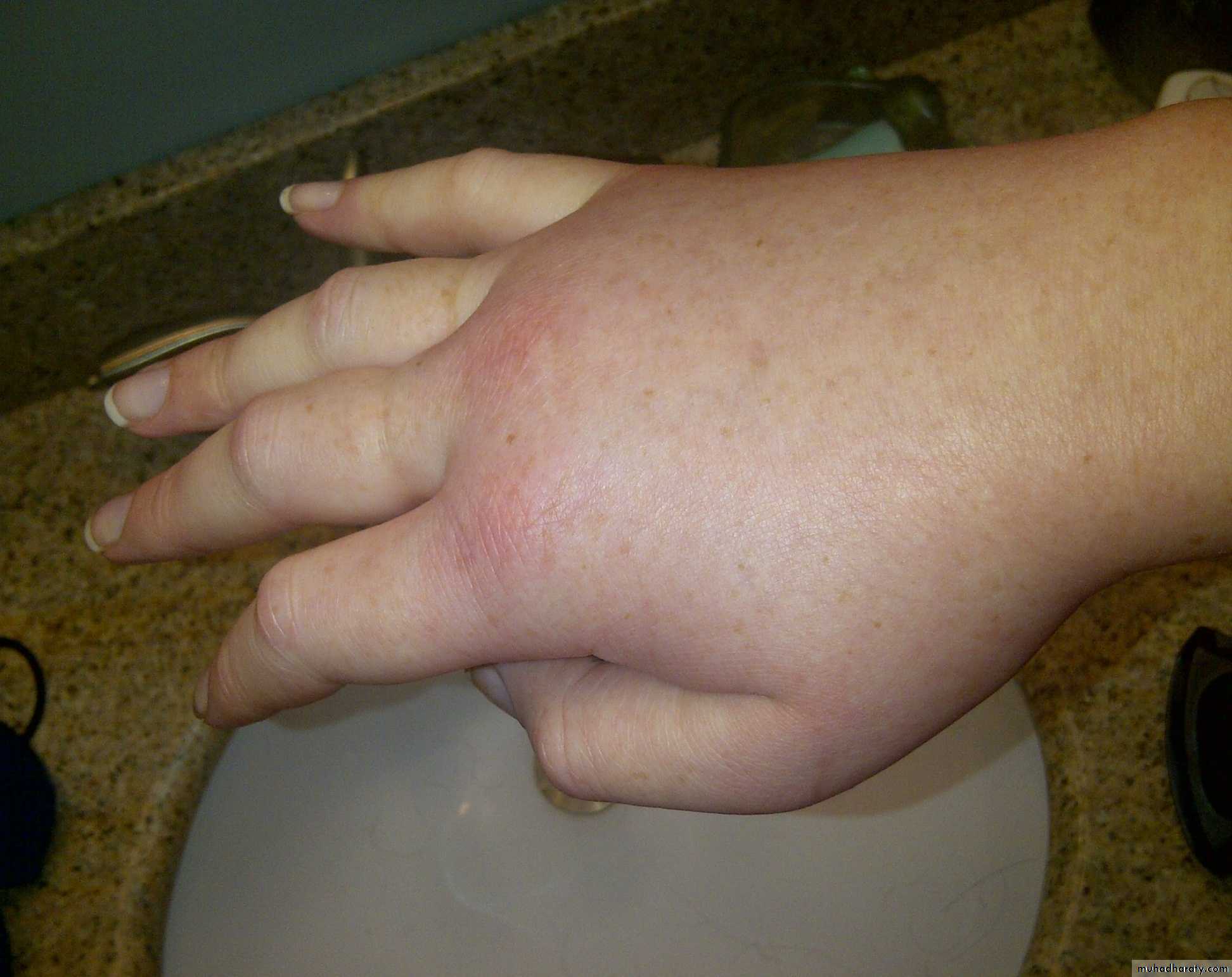 urticaria and angioedema