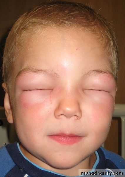 urticaria and angioedema