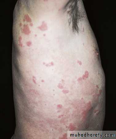 urticaria and angioedema