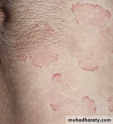 urticaria and angioedema