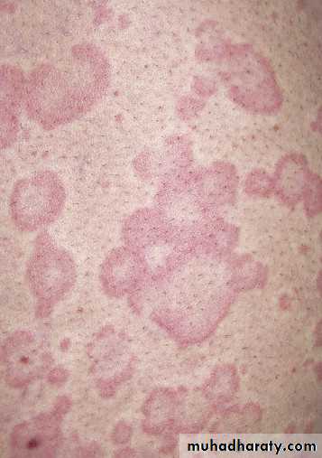 urticaria and angioedema