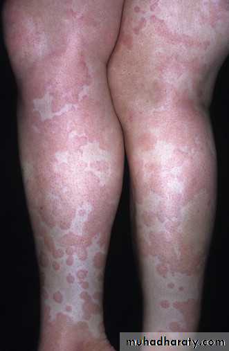 urticaria and angioedema