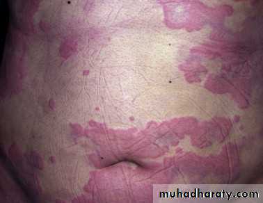 urticaria and angioedema