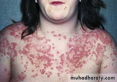 urticaria and angioedema