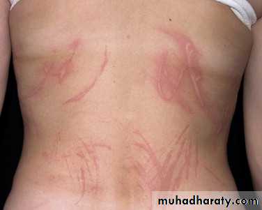 urticaria and angioedema