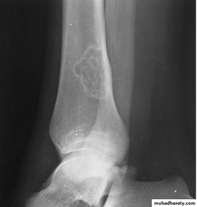 BONE