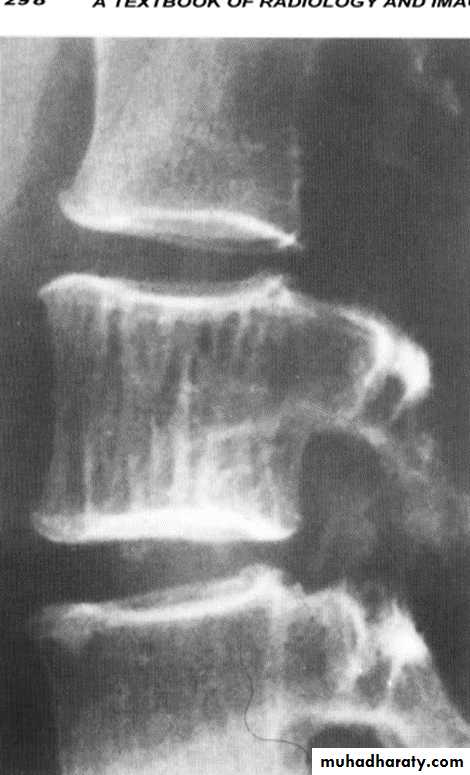 BONE