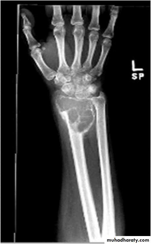 BONE