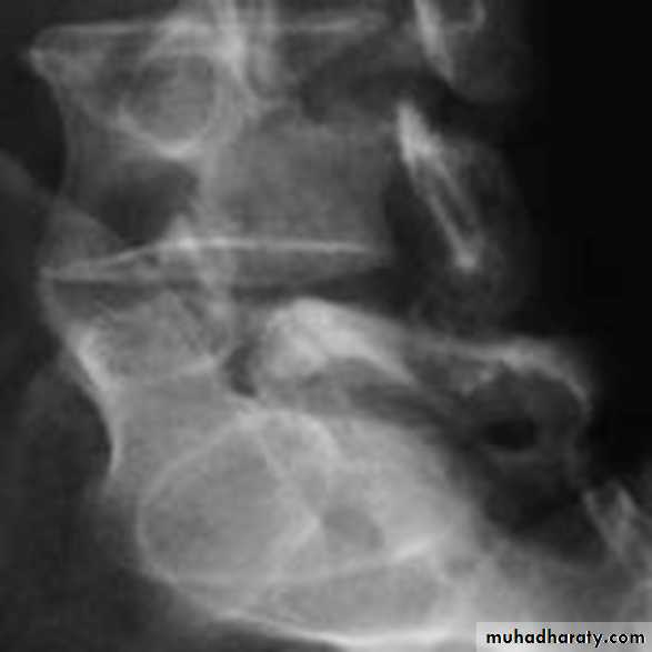 BONE
