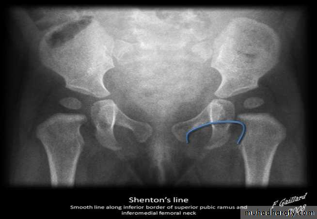 BONE