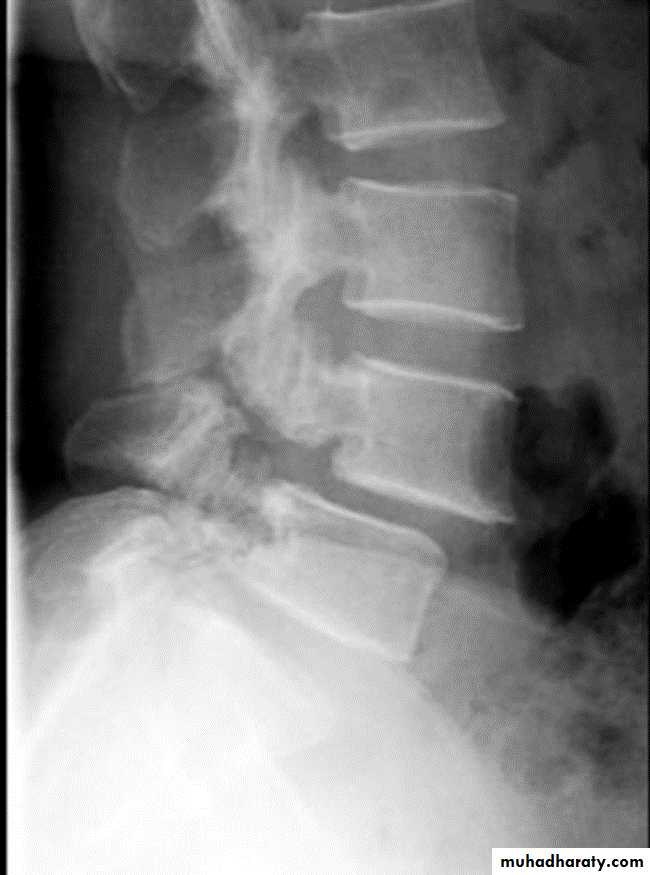 BONE