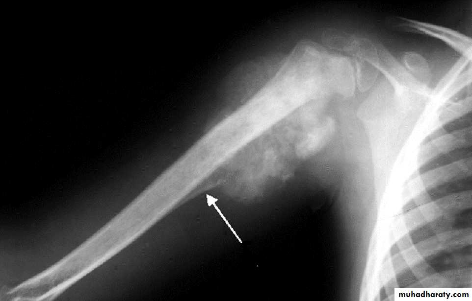 BONE