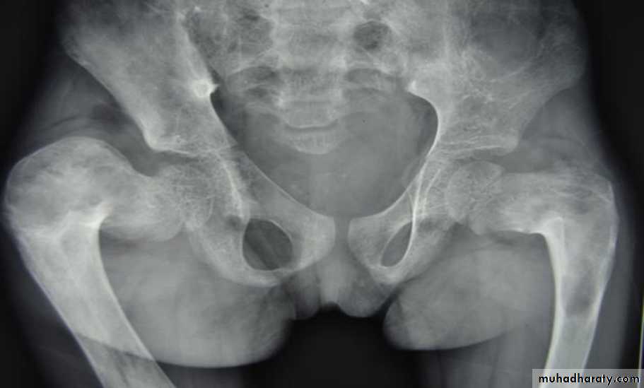 BONE