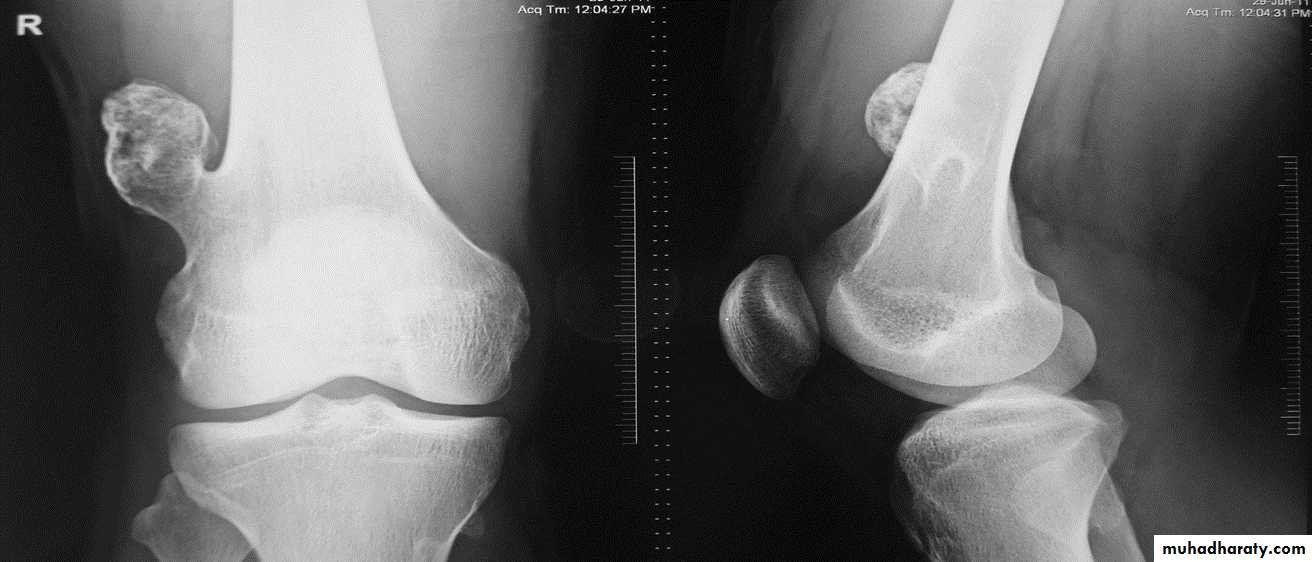 BONE