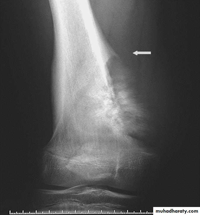 BONE