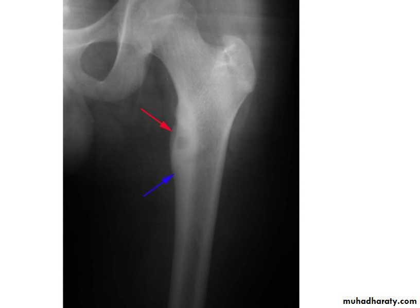 BONE