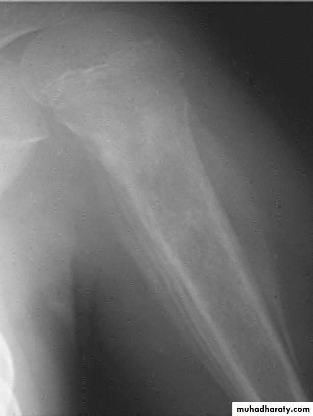 BONE