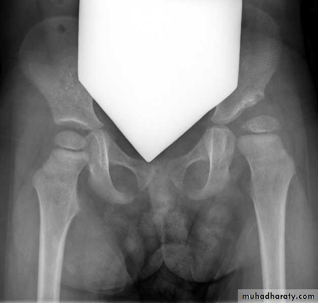 BONE