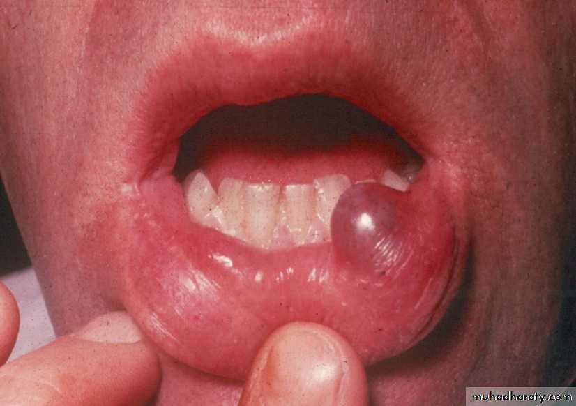 Diseases of salivary glands