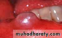 Diseases of salivary glands