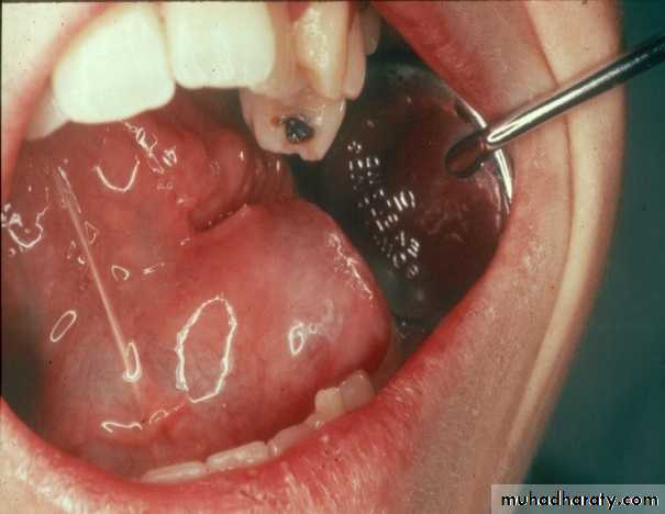 Diseases of salivary glands