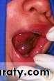 Diseases of salivary glands