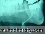 Diseases of salivary glands