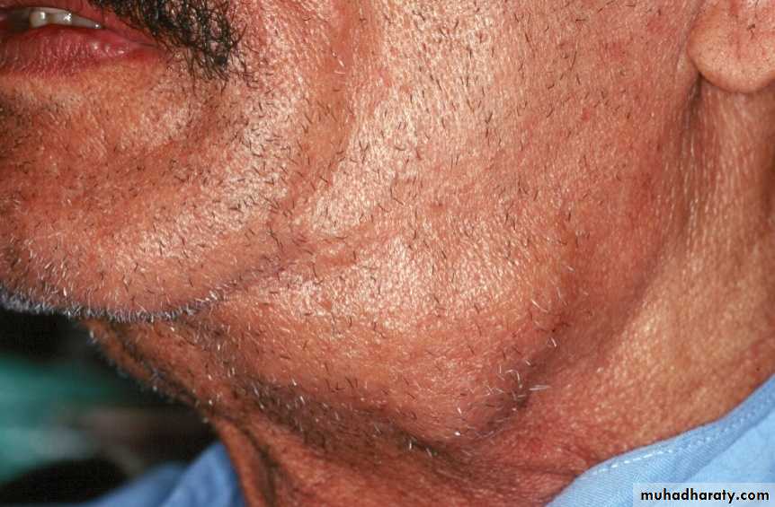 Diseases of salivary glands