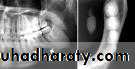 Diseases of salivary glands