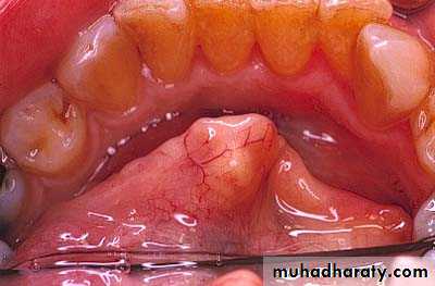 Diseases of salivary glands