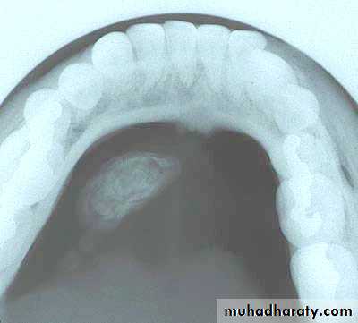 Diseases of salivary glands