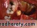 Diseases of salivary glands