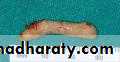 Diseases of salivary glands
