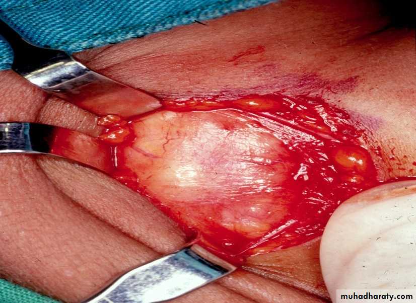 Diseases of salivary glands