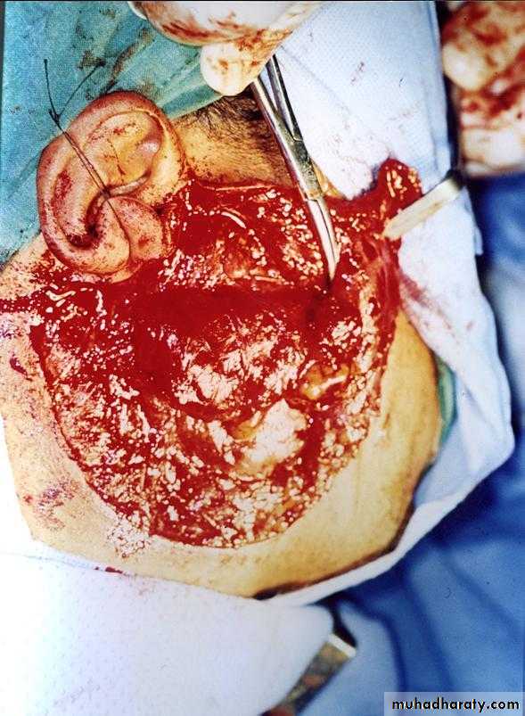 Diseases of salivary glands