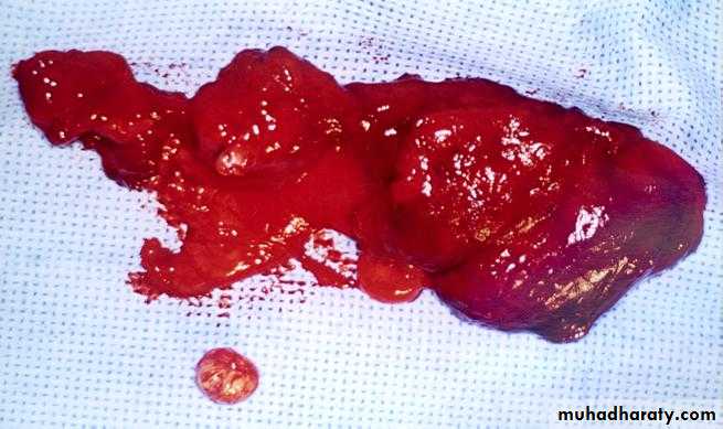 Diseases of salivary glands