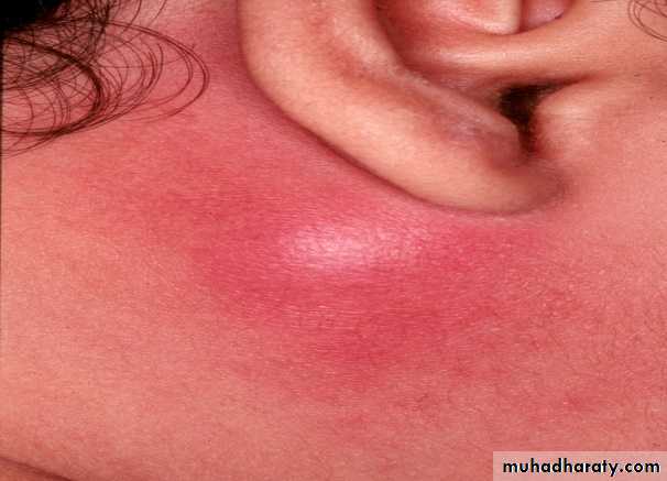 Diseases of salivary glands