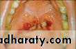 Diseases of salivary glands