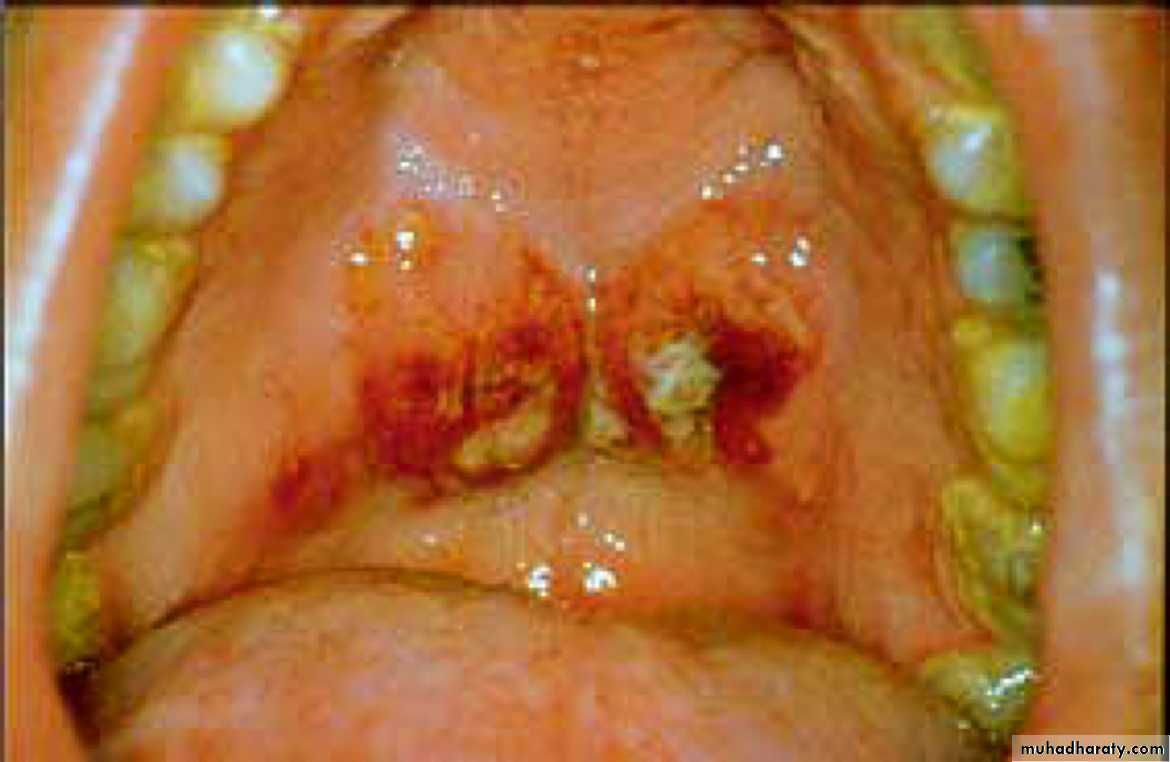 Diseases of salivary glands